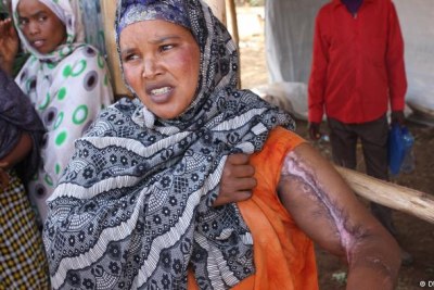 An Ethiopian woman shows the injury she suffered.